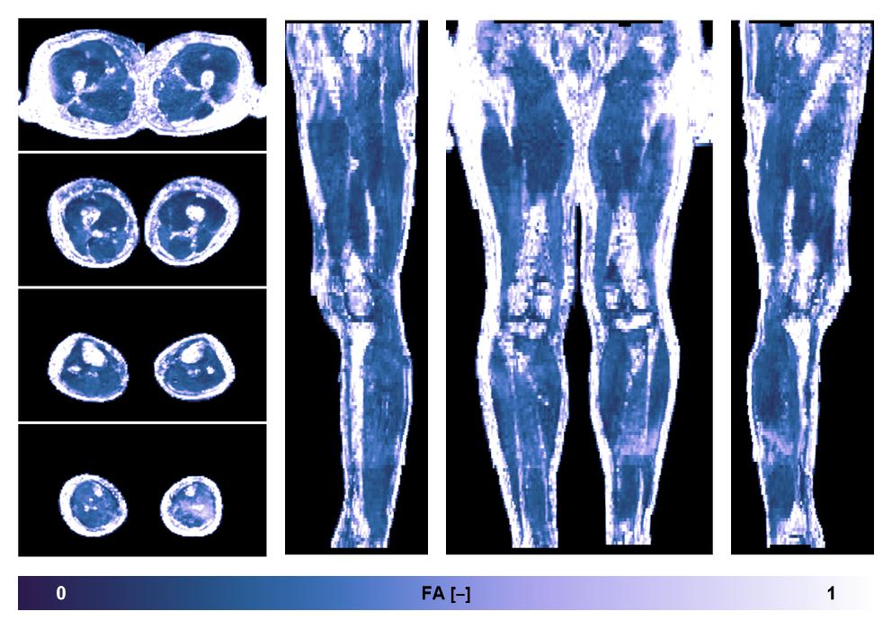IVIM corrected whole leg muscle fractional anisotropy obtained from diffusion tensor imaging.