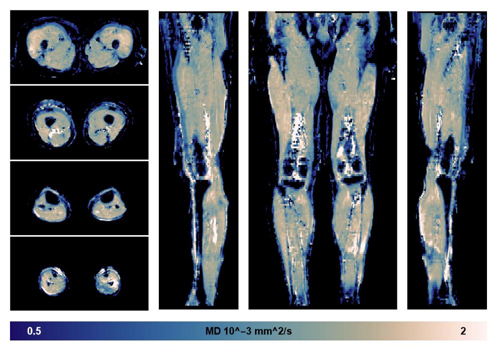 IVIM corrected whole leg muscle mean diffusivity obtained from diffusion tensor imaging.