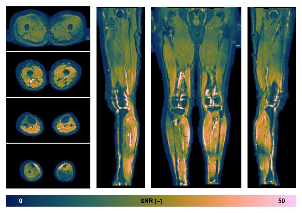 SNR distribution of the unweighted diffusion data.