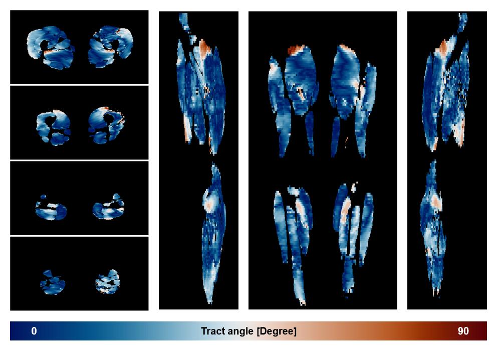Muscle fiber tract angle map based on whole leg DTI based fiber tractography.