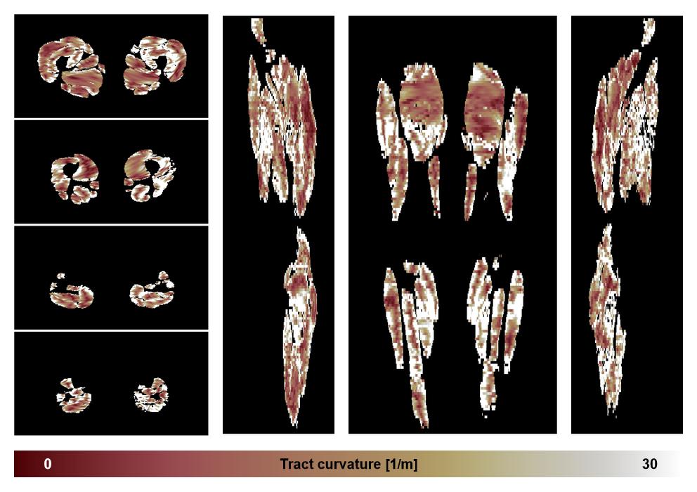 Muscle fiber tract curvature map based on whole leg DTI based fiber tractography.