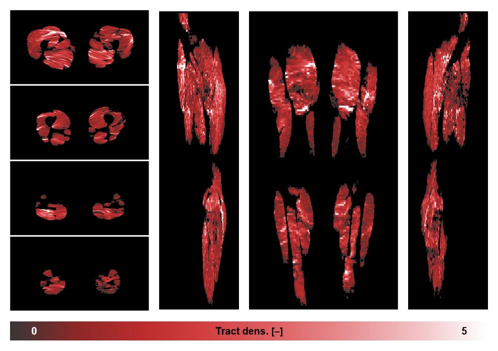 Muscle fiber tract density map based on whole leg DTI based fiber tractography.