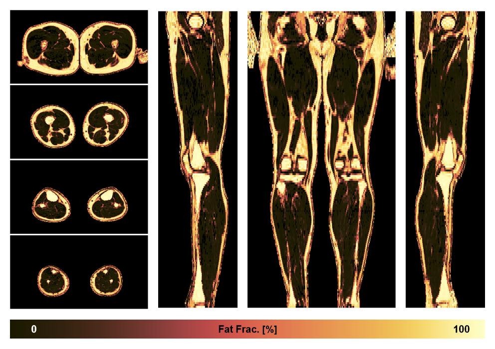 The fat fraction of the lower extremity obtained from the dixon reconstruction for muscle water fat quantification.