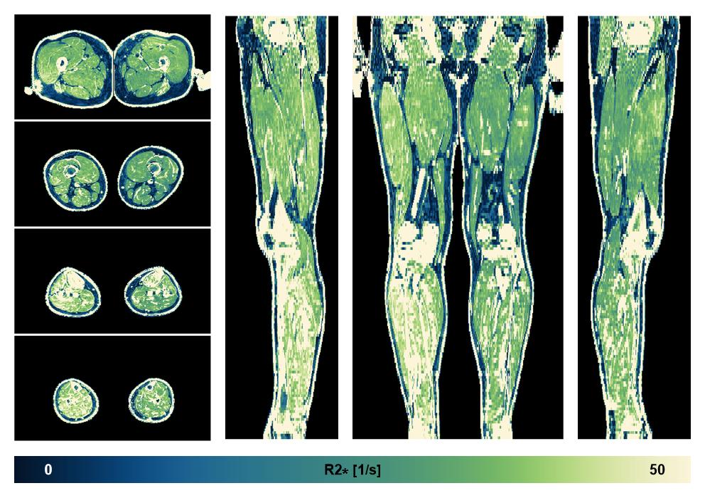 The R2 star relaxation time of the lower extremity obtained from the dixon reconstruction for muscle water fat quantification.