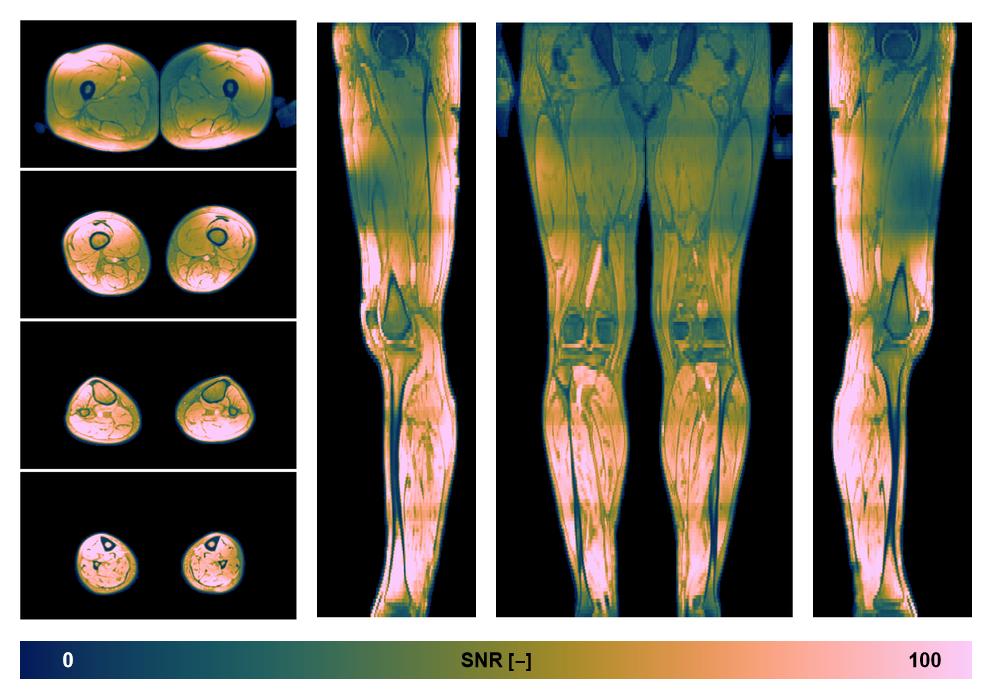 The SNR distribution of the dixon data.