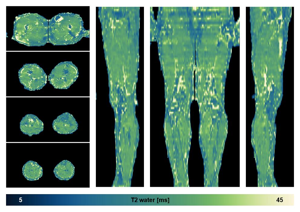 The water only T2 relaxation time of the lower extremity obtained from multi echo spin echo t2 mapping with EPG based reconstruction.