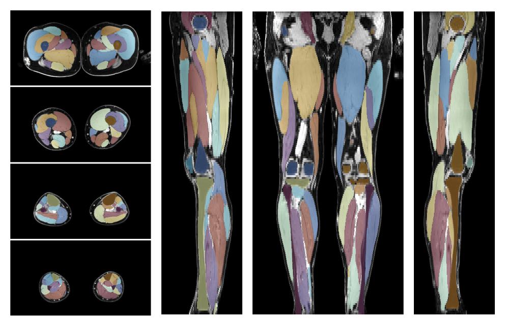 Overlay of automated muscle segmentation labels on dixon water image.