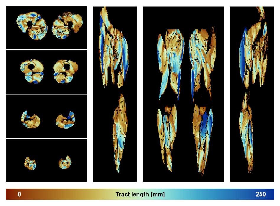 Muscle fiber tract length map based on whole leg DTI based fiber tractography.