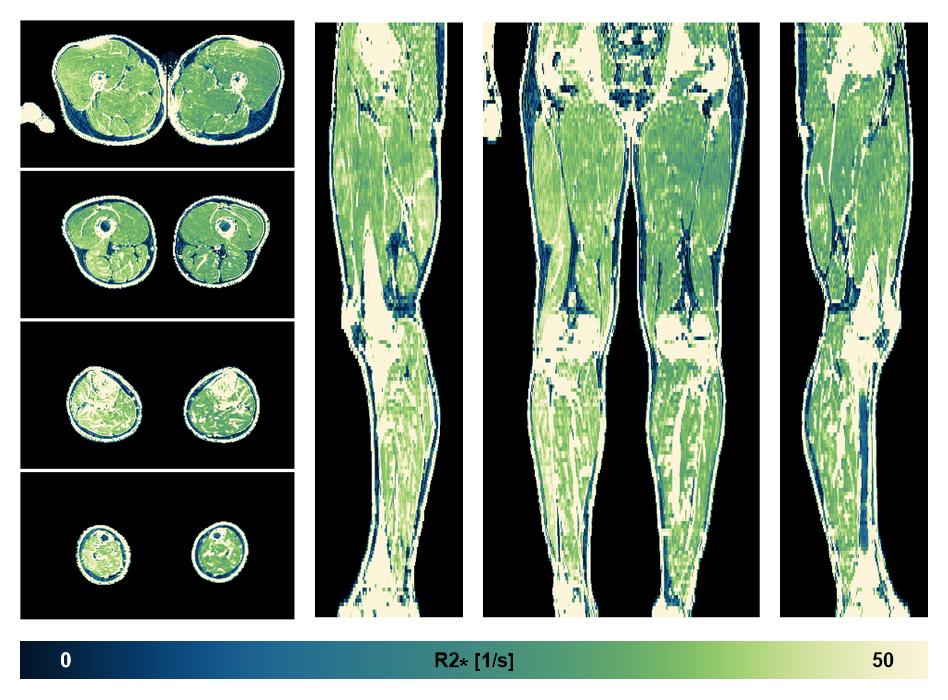 The R2 star relaxation time of the lower extremity obtained from the dixon reconstruction for muscle water fat quantification.