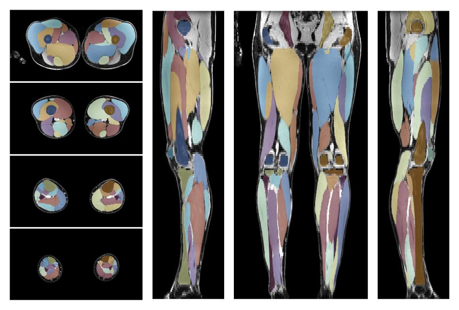 Overlay of automated muscle segmentation labels on dixon water image.