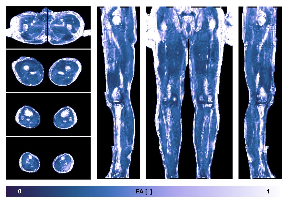 IVIM corrected whole leg muscle fractional anisotropy obtained from diffusion tensor imaging.