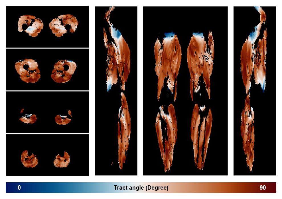 Muscle fiber tract angle map based on whole leg DTI based fiber tractography.