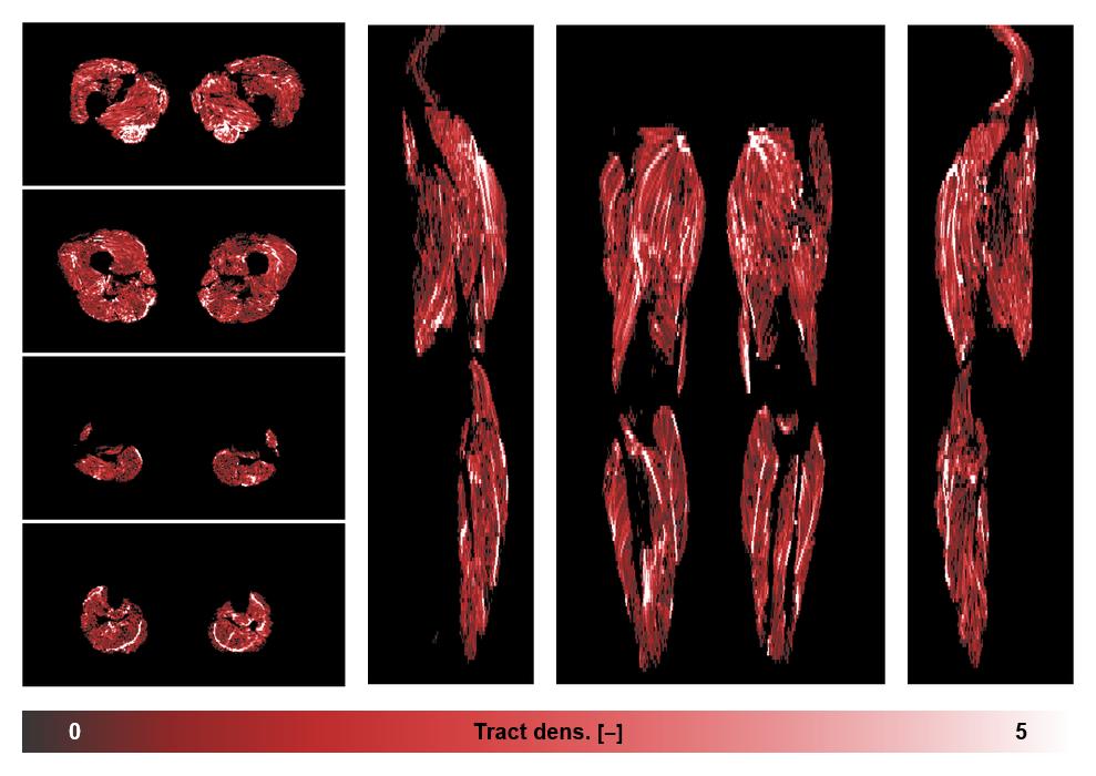 Muscle fiber tract density map based on whole leg DTI based fiber tractography.