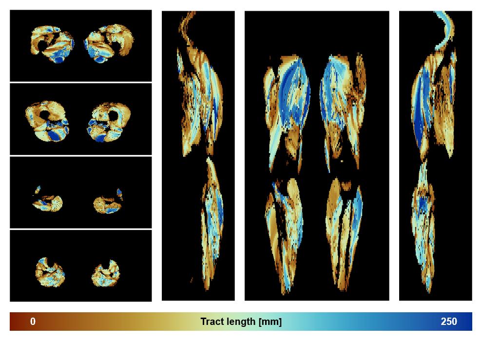 Muscle fiber tract length map based on whole leg DTI based fiber tractography.