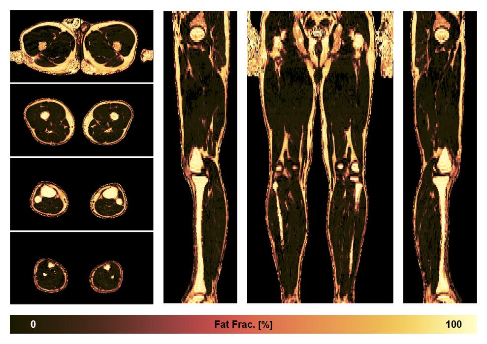 The fat fraction of the lower extremity obtained from the dixon reconstruction for muscle water fat quantification.