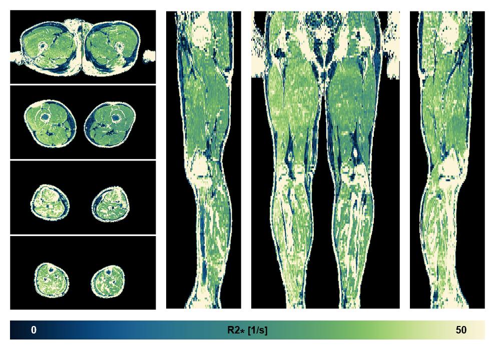 The R2 star relaxation time of the lower extremity obtained from the dixon reconstruction for muscle water fat quantification.