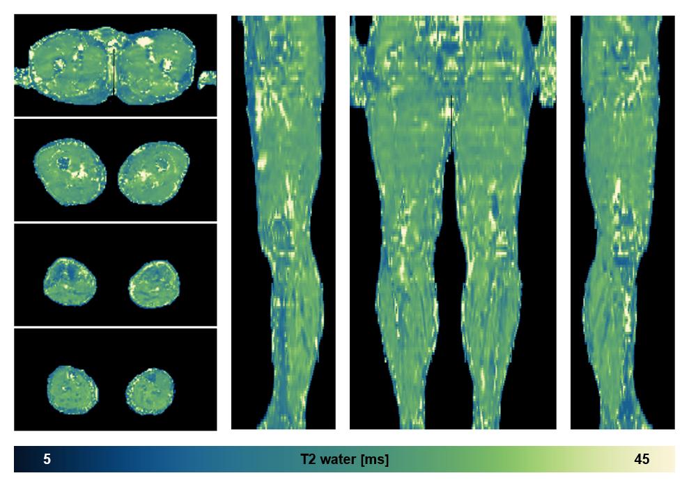 The water only T2 relaxation time of the lower extremity obtained from multi echo spin echo t2 mapping with EPG based reconstruction.
