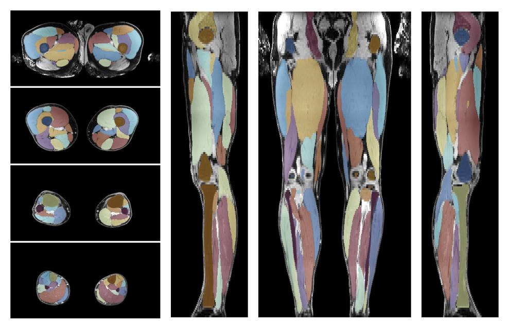Overlay of automated muscle segmentation labels on dixon water image.