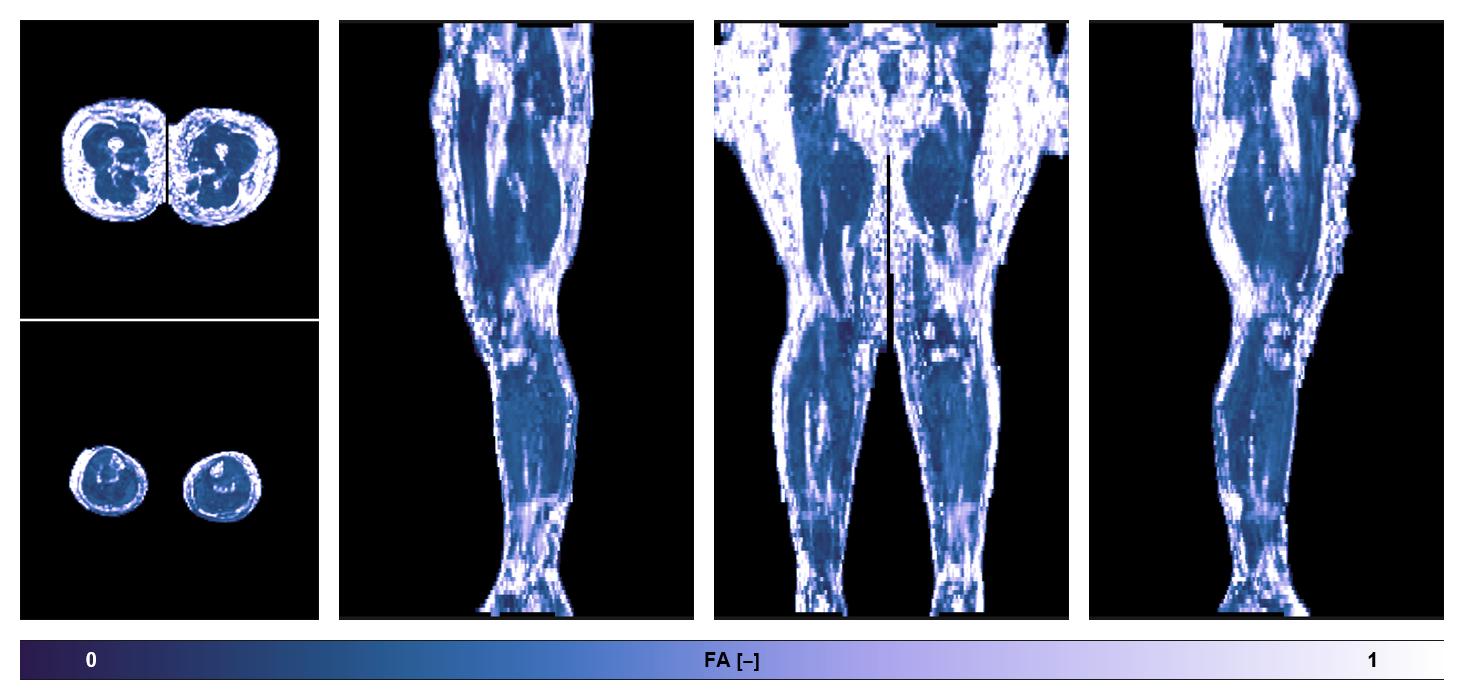 IVIM corrected whole leg muscle fractional anisotropy obtained from diffusion tensor imaging.