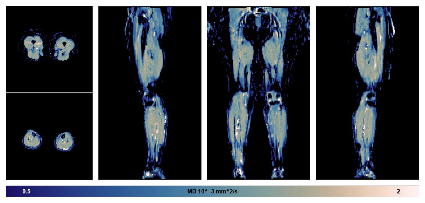 IVIM corrected whole leg muscle mean diffusivity obtained from diffusion tensor imaging.