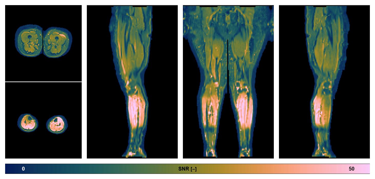 SNR distribution of the unweighted diffusion data.