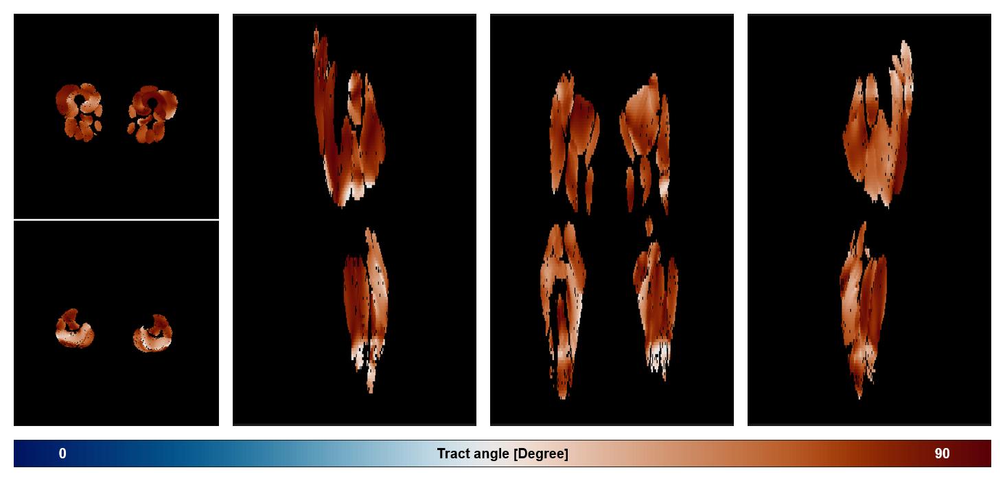 Muscle fiber tract angle map based on whole leg DTI based fiber tractography.
