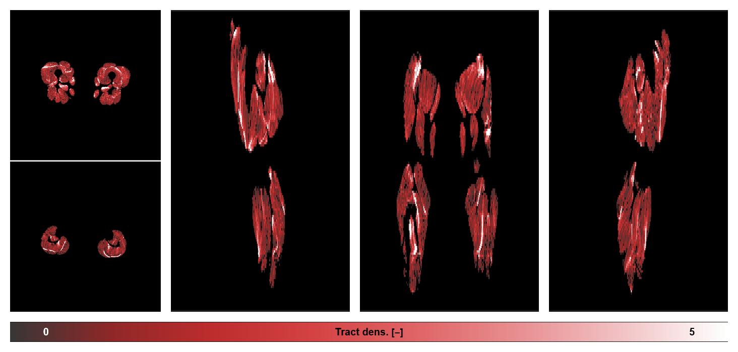 Muscle fiber tract density map based on whole leg DTI based fiber tractography.