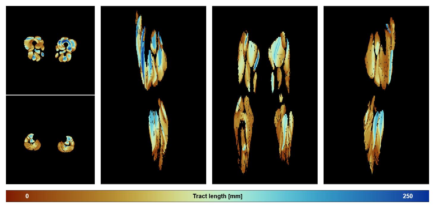 Muscle fiber tract length map based on whole leg DTI based fiber tractography.