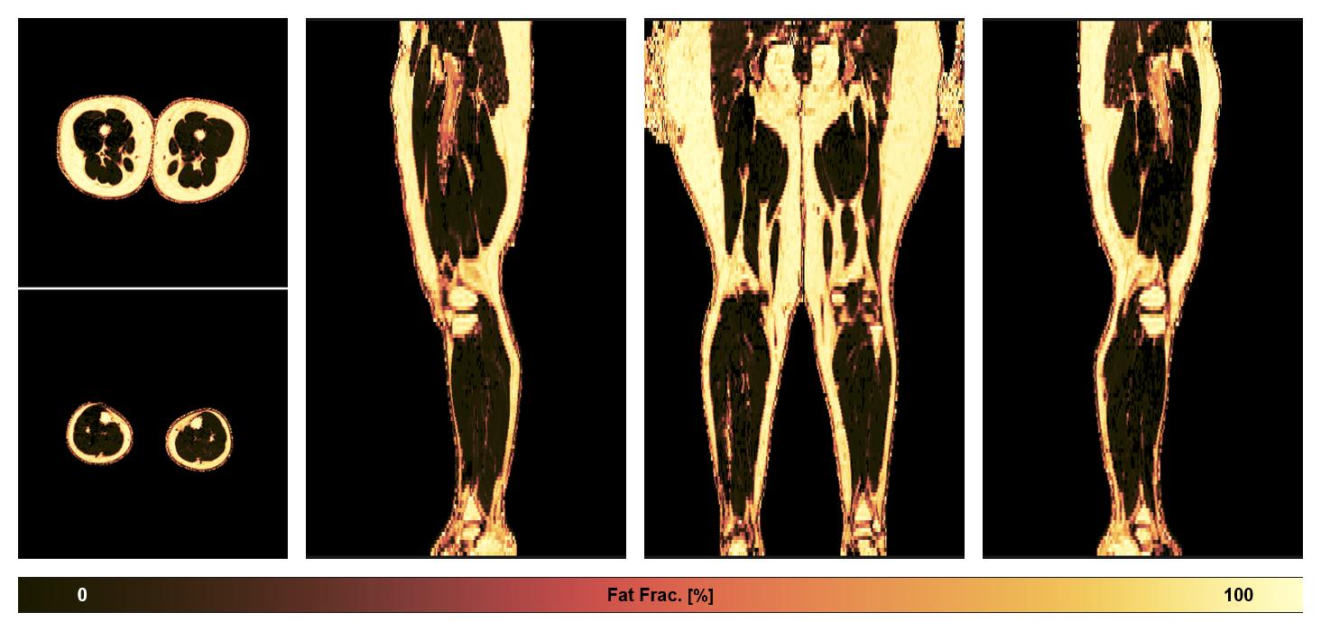 The fat fraction of the lower extremity obtained from the dixon reconstruction for muscle water fat quantification.