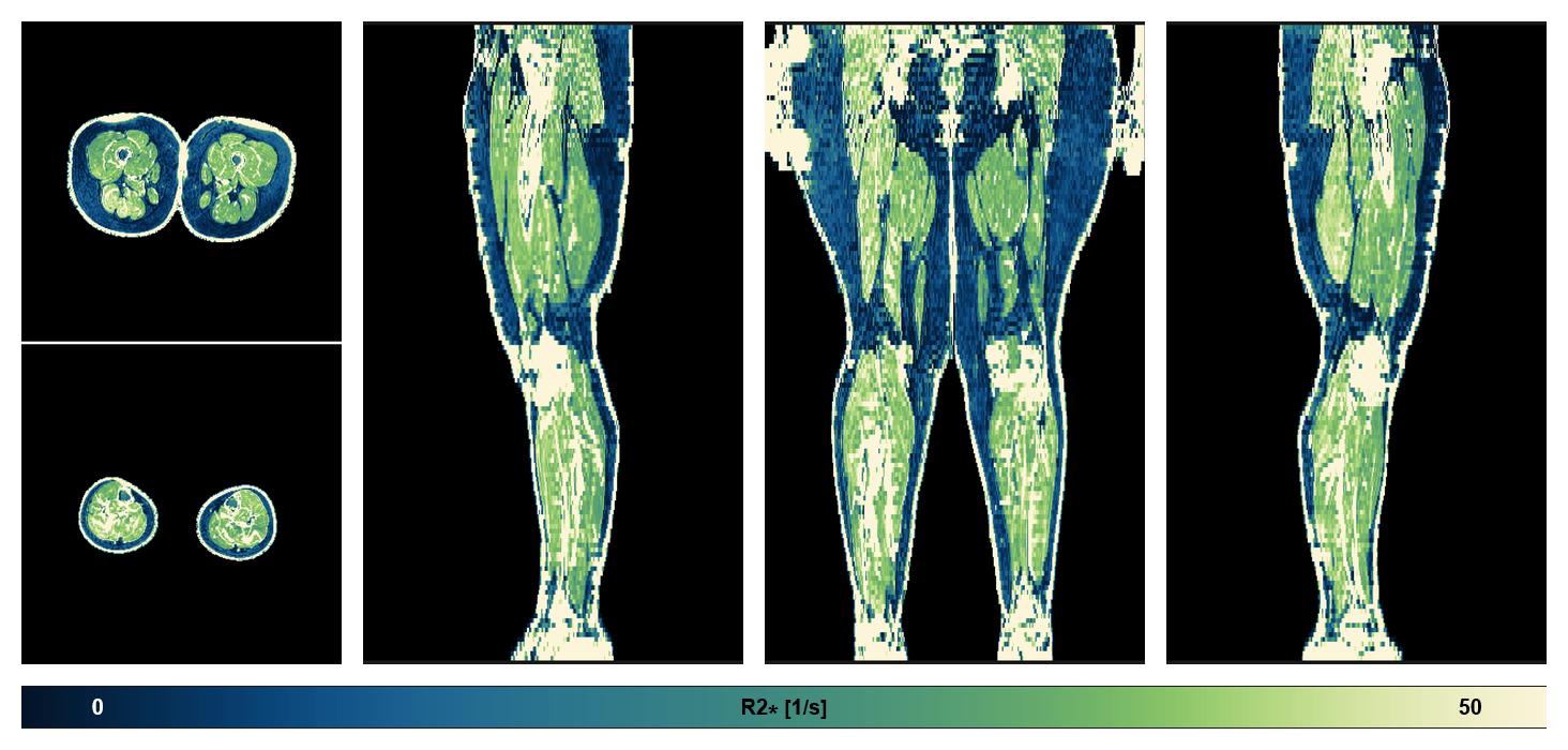 The R2 star relaxation time of the lower extremity obtained from the dixon reconstruction for muscle water fat quantification.
