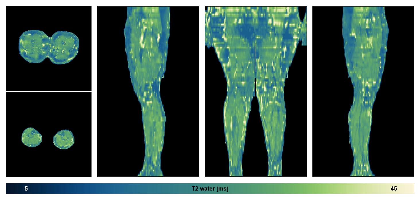 The water only T2 relaxation time of the lower extremity obtained from multi echo spin echo t2 mapping with EPG based reconstruction.