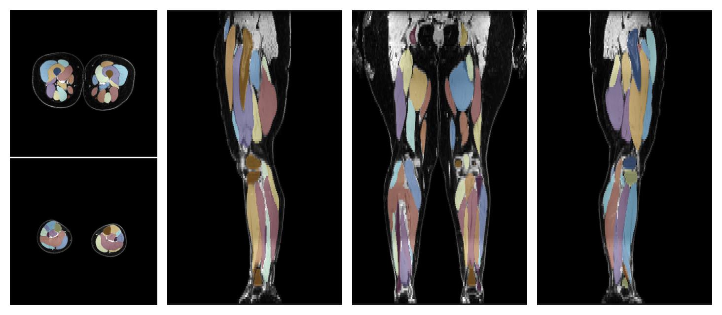 Overlay of automated muscle segmentation labels on dixon water image.