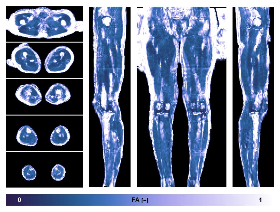 IVIM corrected whole leg muscle fractional anisotropy obtained from diffusion tensor imaging.