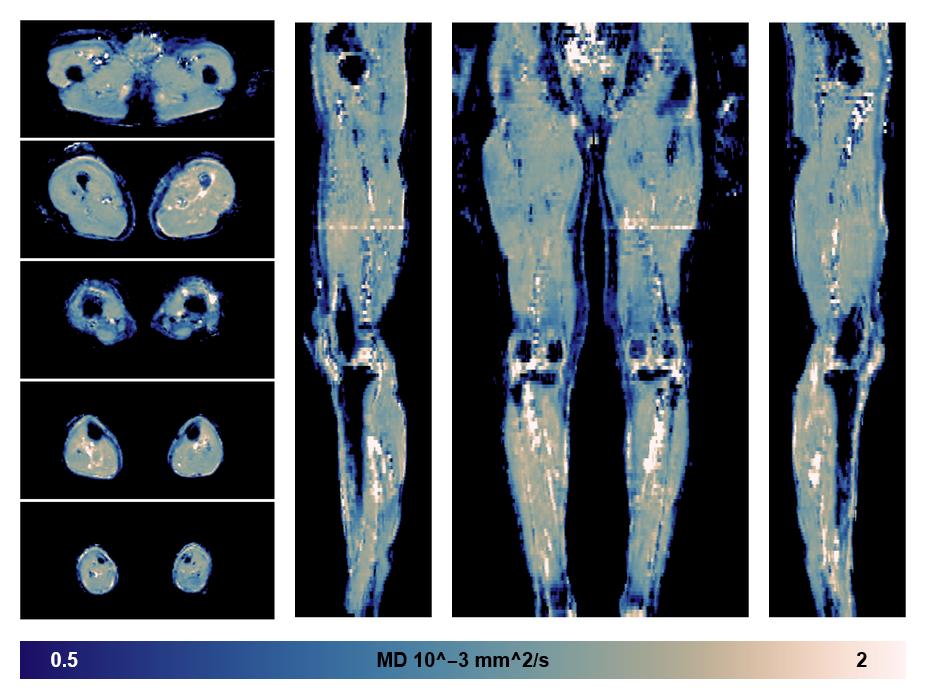 IVIM corrected whole leg muscle mean diffusivity obtained from diffusion tensor imaging.