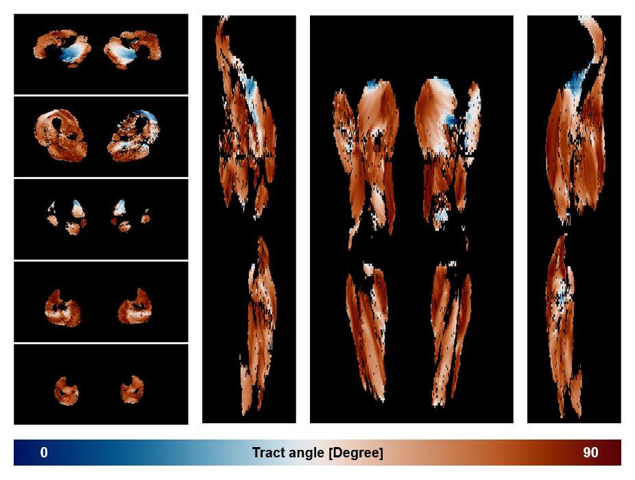 Muscle fiber tract angle map based on whole leg DTI based fiber tractography.