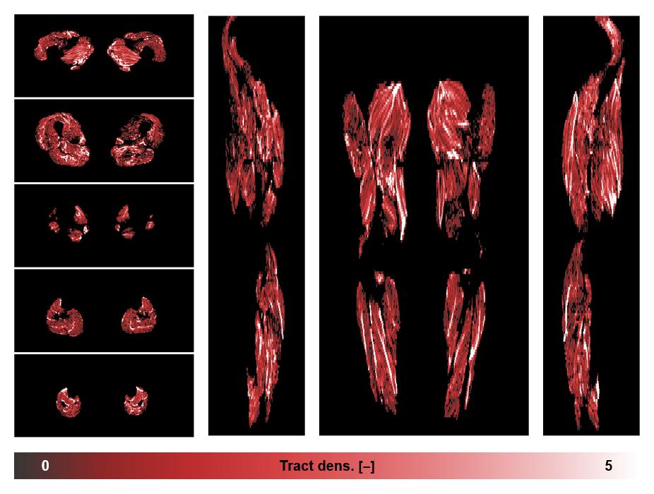 Muscle fiber tract density map based on whole leg DTI based fiber tractography.