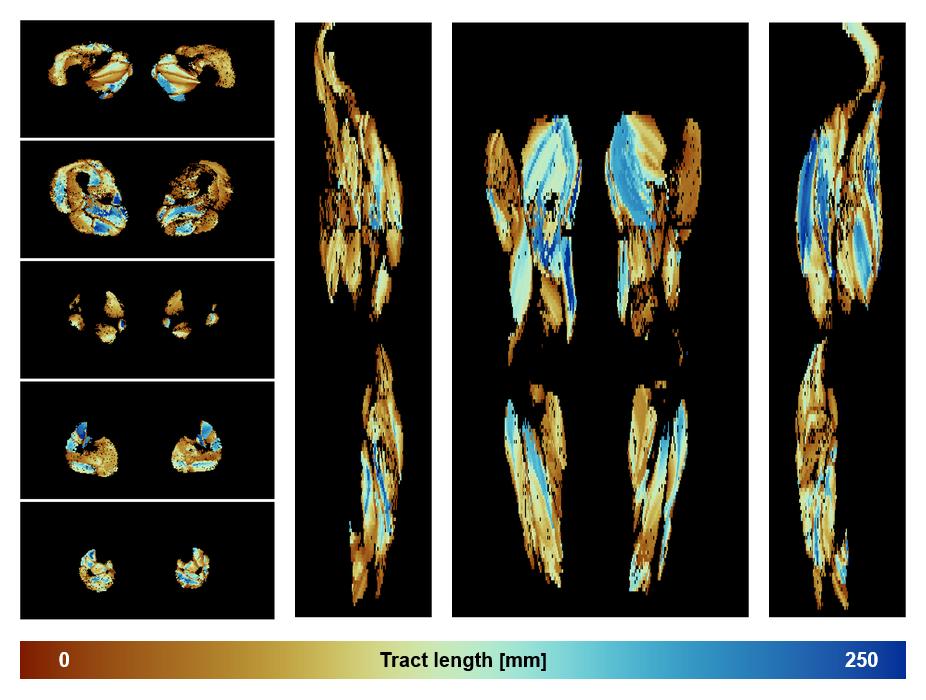 Muscle fiber tract length map based on whole leg DTI based fiber tractography.