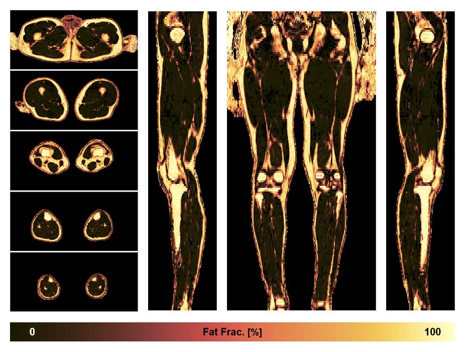 The fat fraction of the lower extremity obtained from the dixon reconstruction for muscle water fat quantification.