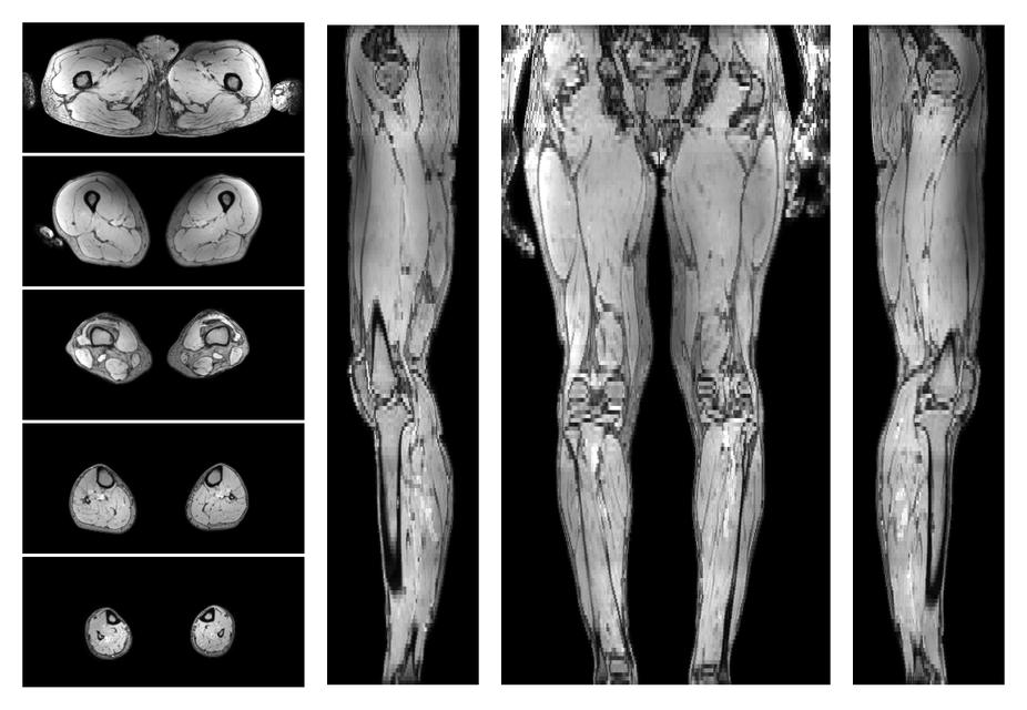 The out-phase image of the dixon reconstruction for water fat quantification.