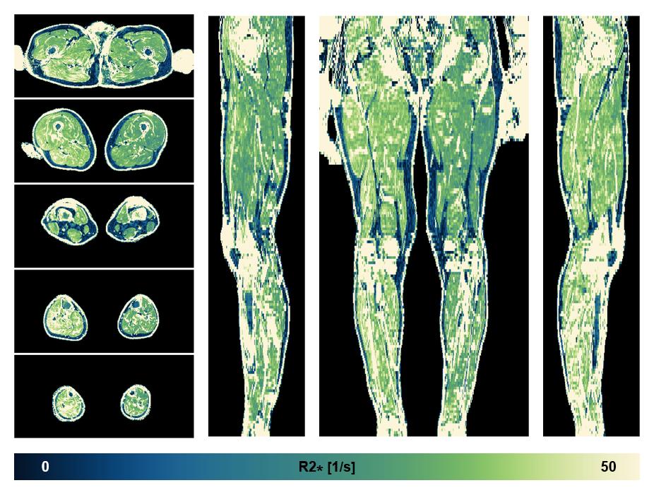The R2 star relaxation time of the lower extremity obtained from the dixon reconstruction for muscle water fat quantification.