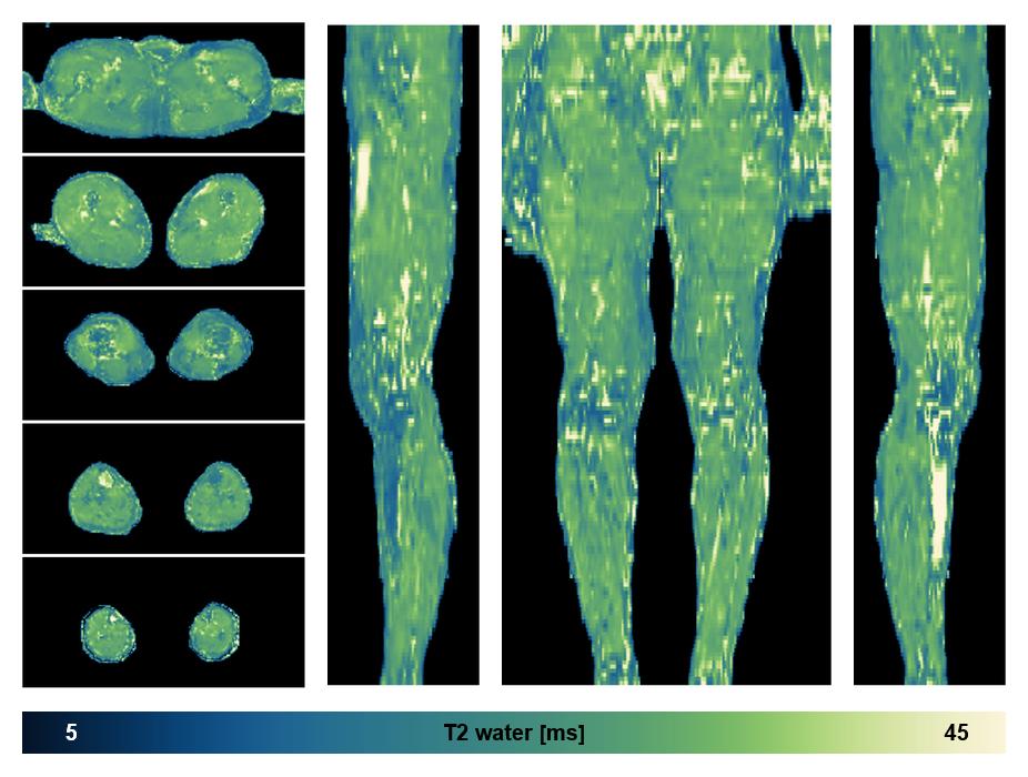 The water only T2 relaxation time of the lower extremity obtained from multi echo spin echo t2 mapping with EPG based reconstruction.