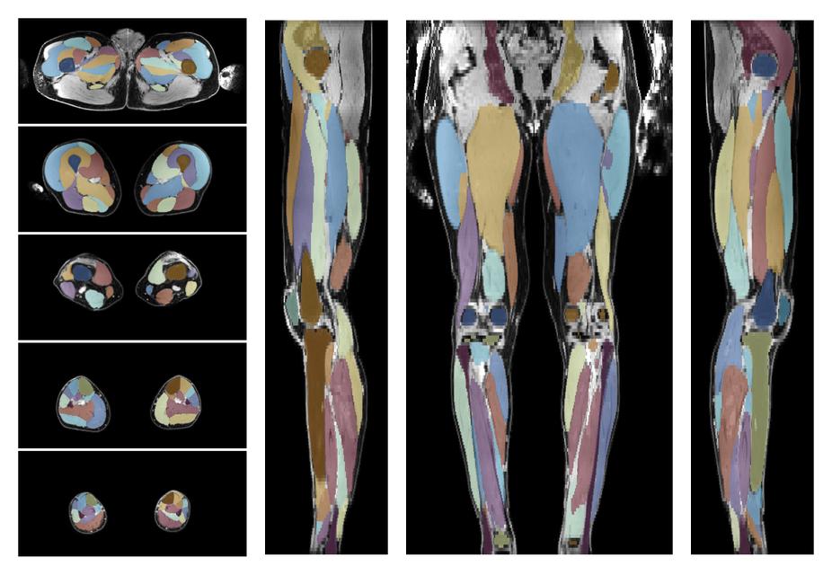 Overlay of automated muscle segmentation labels on dixon water image.
