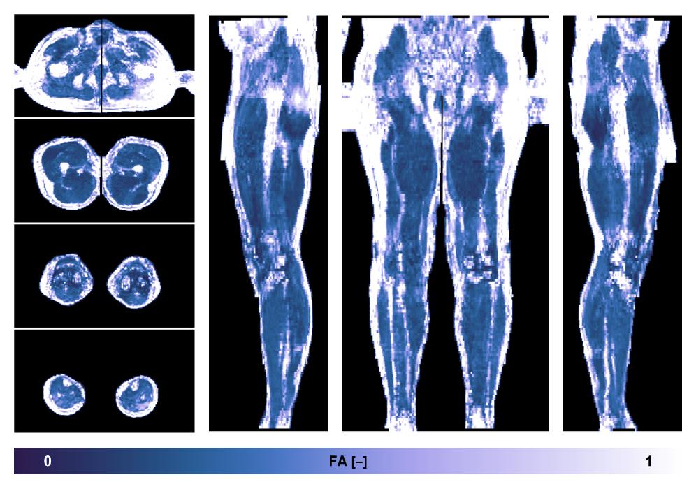 IVIM corrected whole leg muscle fractional anisotropy obtained from diffusion tensor imaging.