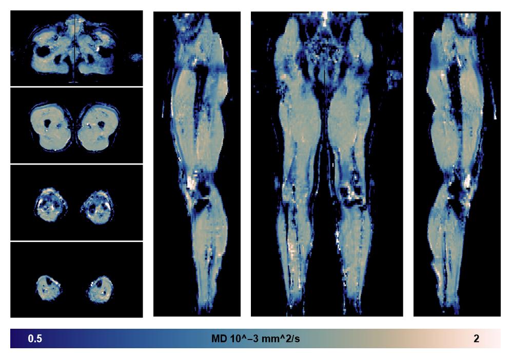 IVIM corrected whole leg muscle mean diffusivity obtained from diffusion tensor imaging.