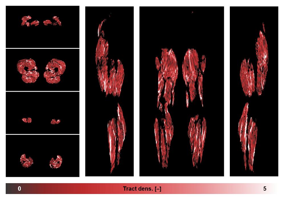 Muscle fiber tract density map based on whole leg DTI based fiber tractography.
