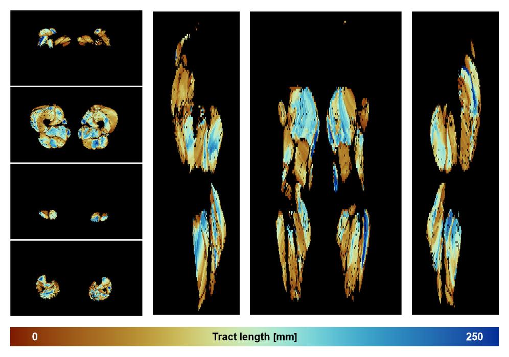 Muscle fiber tract length map based on whole leg DTI based fiber tractography.