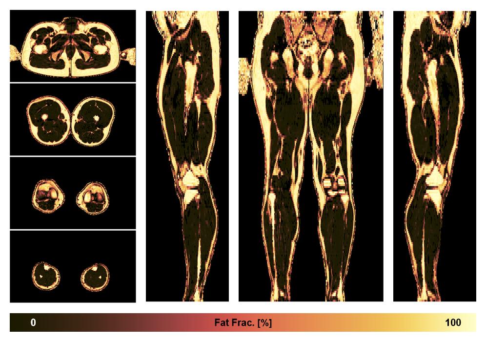 The fat fraction of the lower extremity obtained from the dixon reconstruction for muscle water fat quantification.
