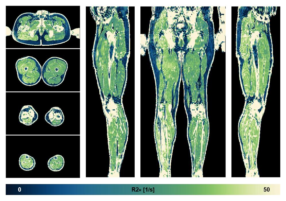 The R2 star relaxation time of the lower extremity obtained from the dixon reconstruction for muscle water fat quantification.