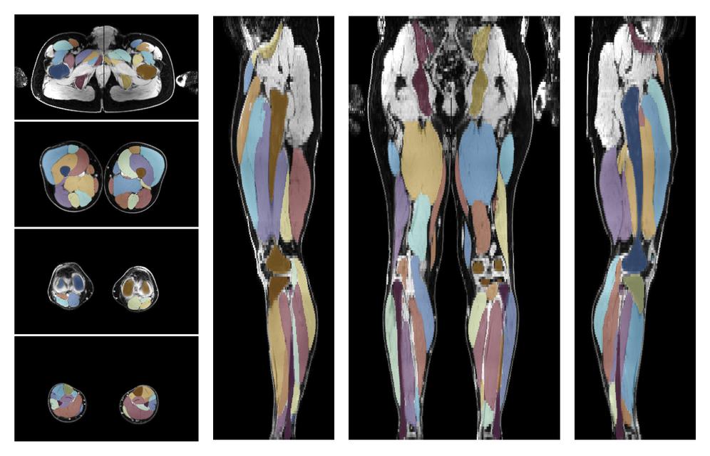 Overlay of automated muscle segmentation labels on dixon water image.