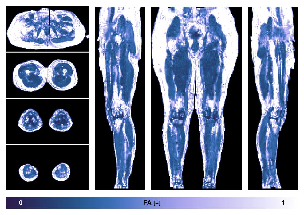 IVIM corrected whole leg muscle fractional anisotropy obtained from diffusion tensor imaging.